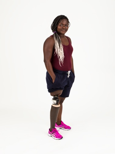 Woman with above-knee prosthesis standing.