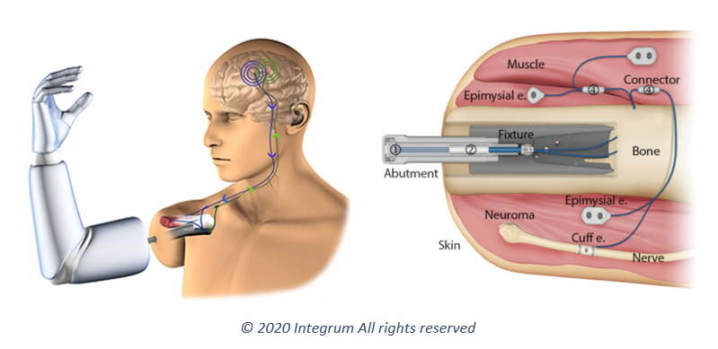 An animated image of Integrum's mind-controlled prosthetic system: The e-OPRA Implant System.